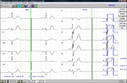 Cardio-Card Resting/Stress Test ECG